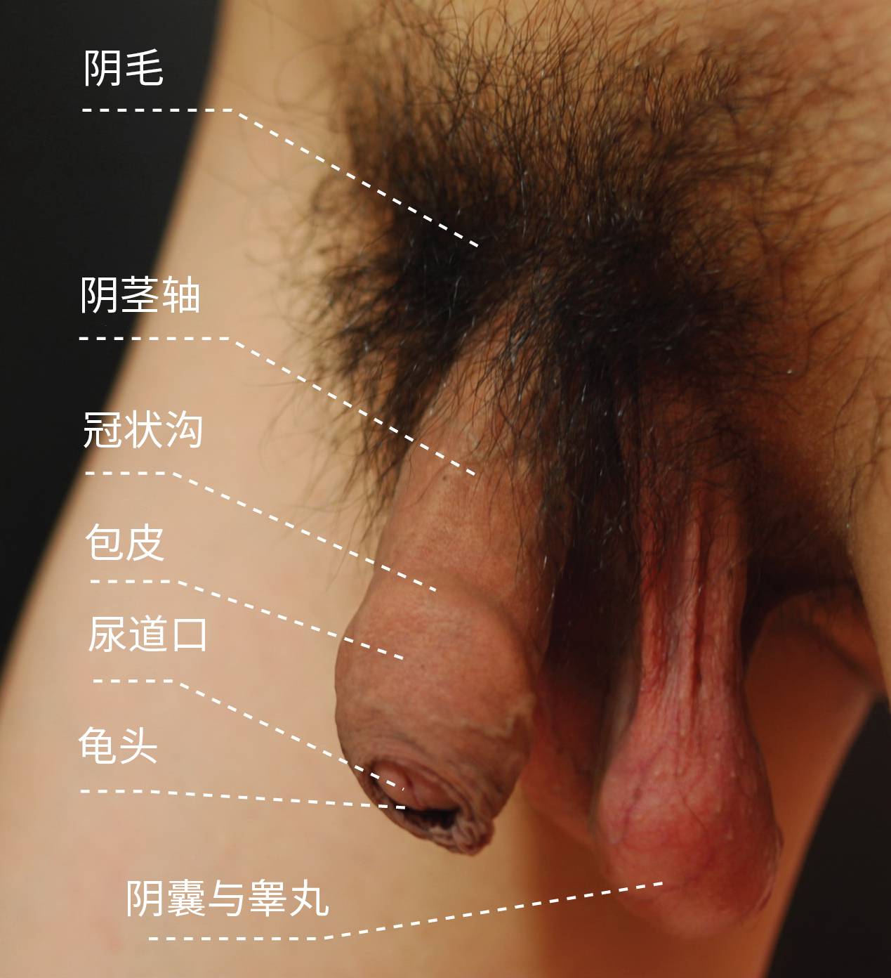 图 4， 亚洲男性外生殖器（疲软状态，包皮覆盖）